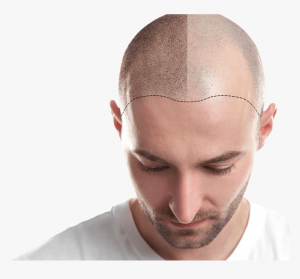 267-2674997_hair-transplant-in-ahmedabad-transplant-add-fue-hair