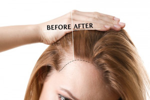 hair-transplant-side-effects